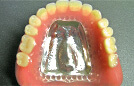 チタン床義歯（片顎）